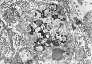 M,40y. | granular cell tumor